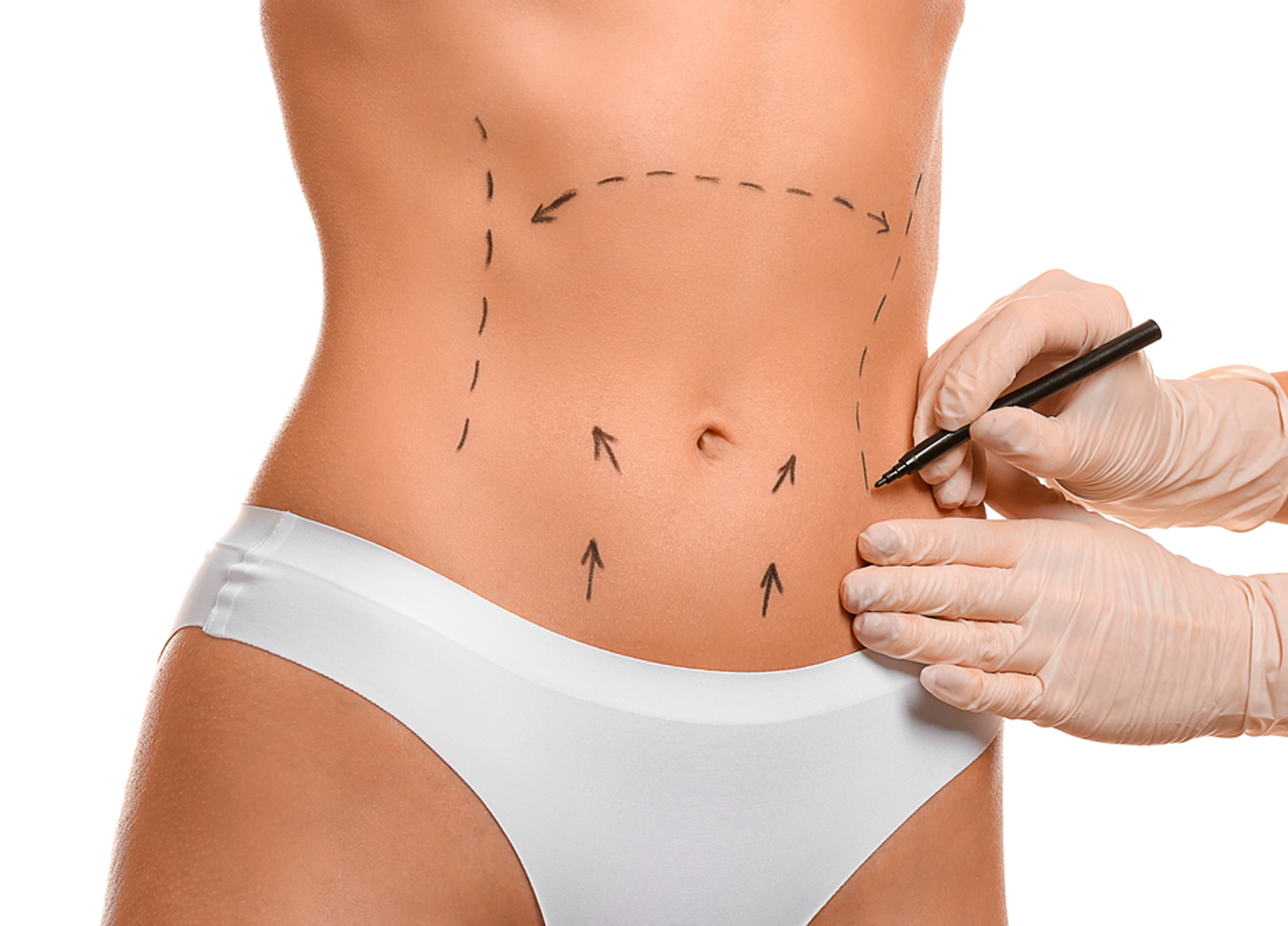 Abdominoplastia